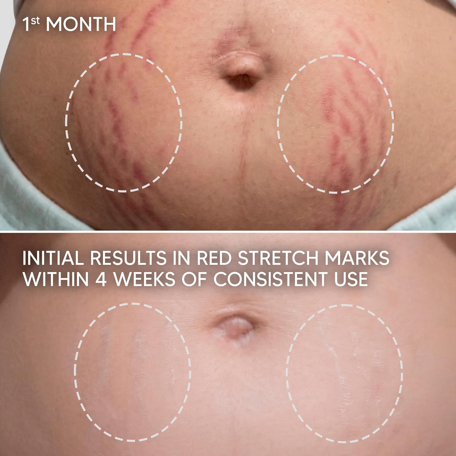 Cicatrissim Targeted Stretch Mark Cream (5.3 Oz)