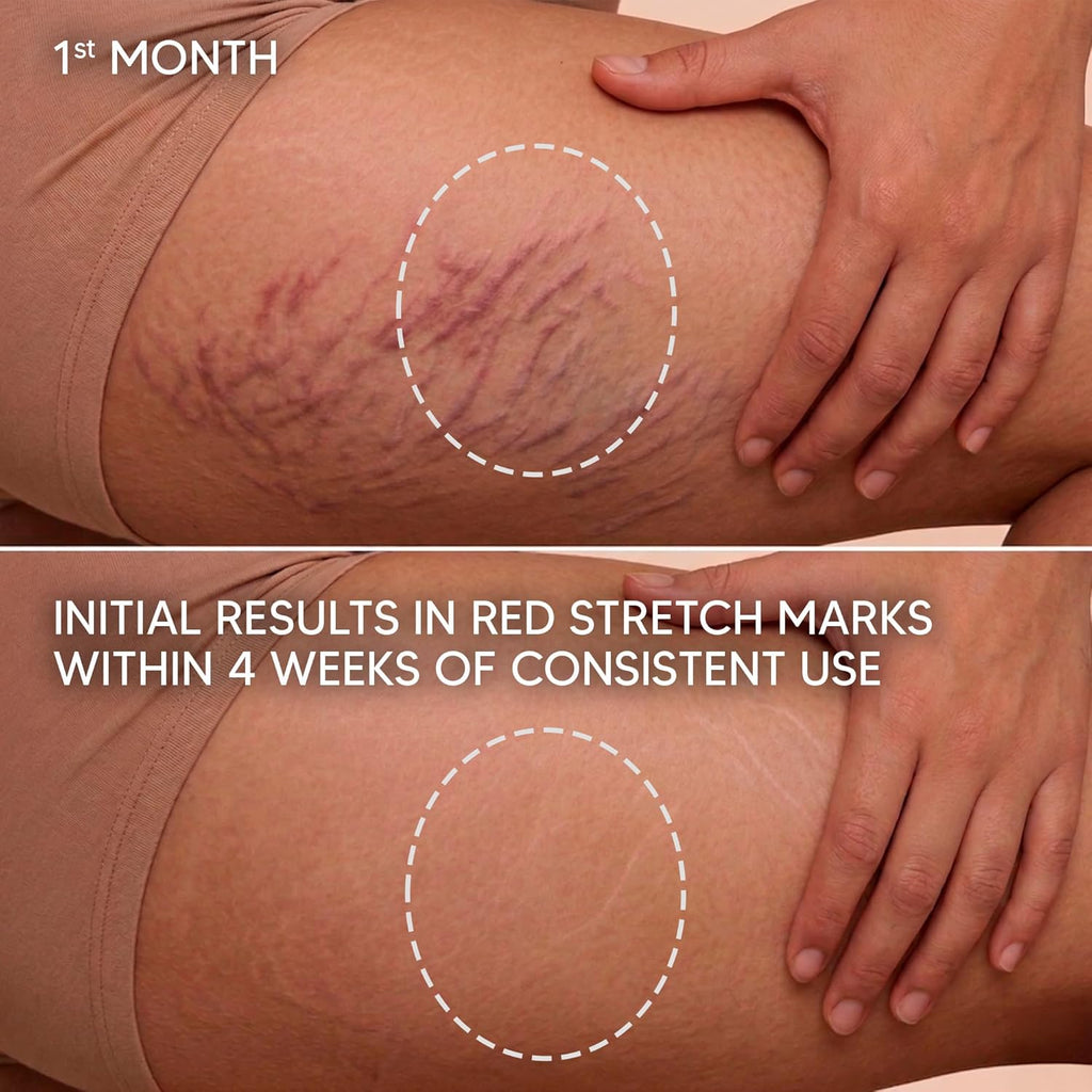 Cicatrissim Targeted Stretch Mark Cream (5.3 Oz)